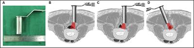 Contralateral approach using microscope and tubular retractor system for ipsilateral decompression of lumbar degenerative lateral recess stenosis associated with narrow spinal canal